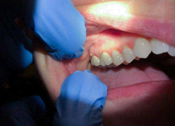 Best Emergency Treatment for Dental Infections or Abscesses in Susanville, CA